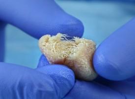 Advanced Medical Cellular Bone Matrix (AM Matrix)